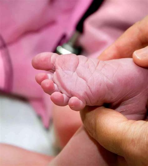 Sacral Dimples in Newborn: Symptoms, Causes And Treatment