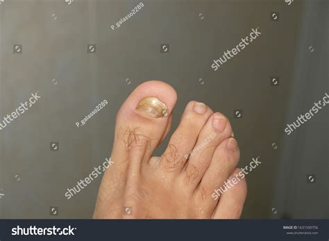 Young Guy Barefoot Fingers Sick Onycho Stock Photo 1631590756 ...