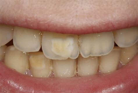 Brown Build Up On Teeth at Joanne Gonzales blog