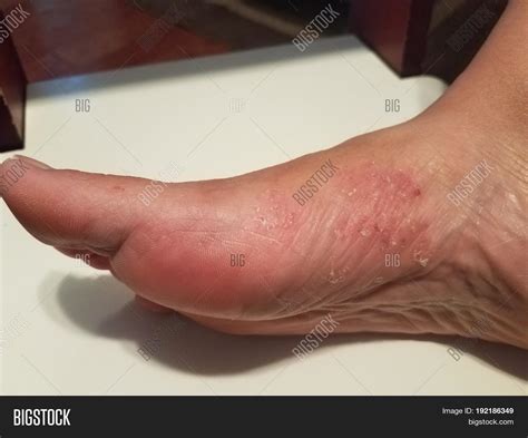 Red Rough Fungus Scaly Image & Photo (Free Trial) | Bigstock