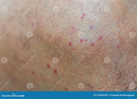 Red Spot and Scar from Mosquito Bites Stock Photo - Image of mosquito ...