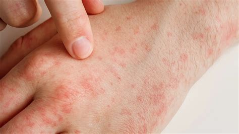 Alergias en la piel | Pruebas de laboratorio