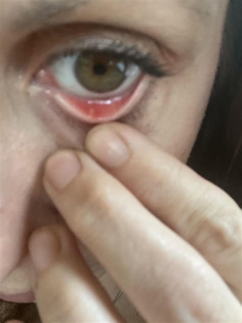 Anyone have painful white bumps in inner bottom eyelid? : r/lupus