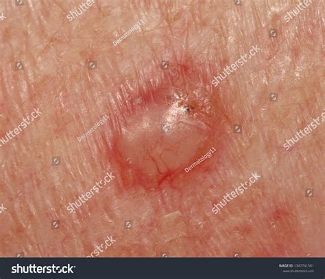 Стоковая фотография 1347741581: Case Nodular Basal Cell Carcinoma | Shutterstock