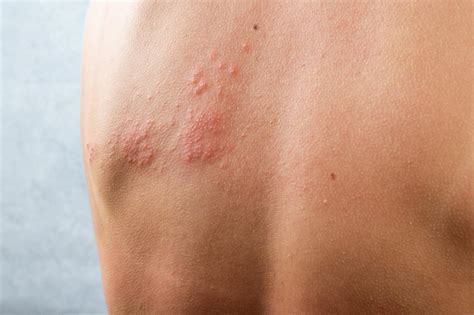 Contact Dermatitis - DermAlly | Specialist Skin Clinic