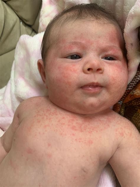 How To Treat Heat Rash On Babies at Dorothy Boots blog