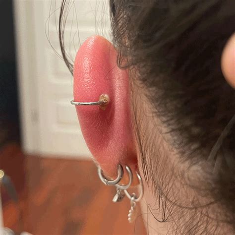 Infected Cartilage Piercings Treatment Infected Cartilage Piercing