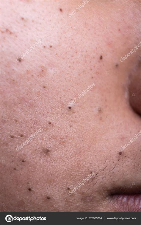 Blackheads On Cheeks