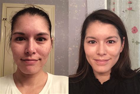 Tretinoin Purge Before And After | Pea-vie