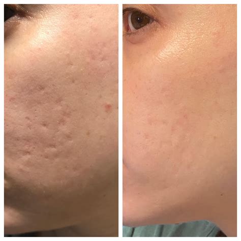 Boxcar Scars Before And After