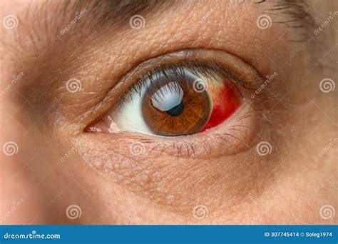 A Human Eye with a Burst Vessel and Blood Leaking into the Eyeball ...