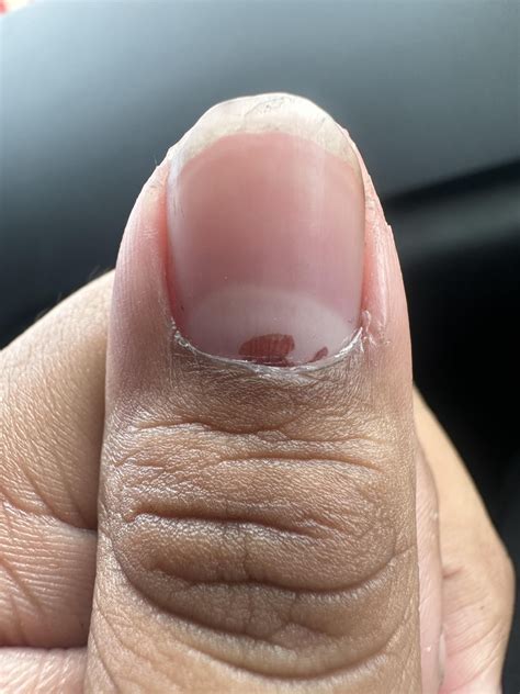 Does anyone know what the red thing on my nail is wont come off : r/DiagnoseMe