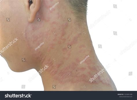 Skin Diseases On Neck Facial Rashes