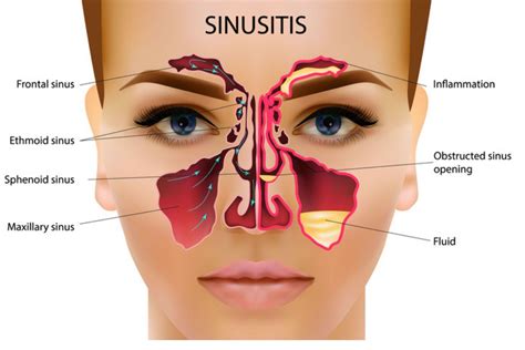 Sinus problems? Natural solutions that work - Patrick Holford