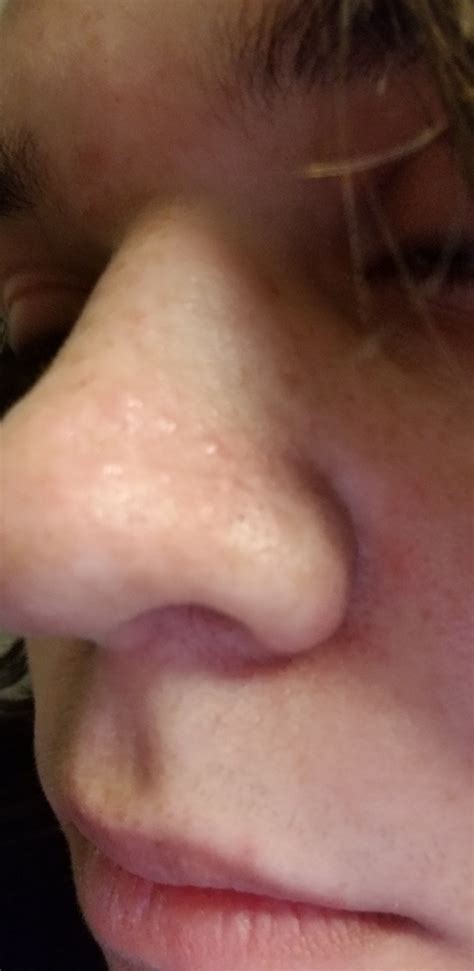 Flesh Colored Bump On Nose