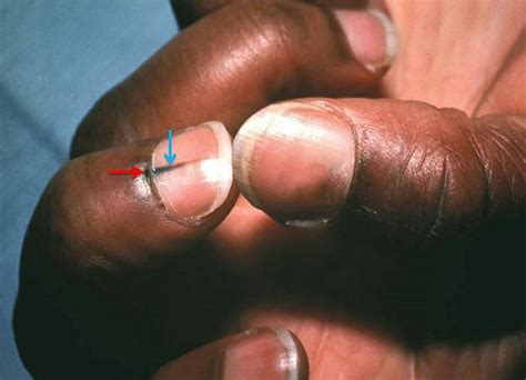 Tumors of the Nails - Skin Disorders - Merck Manual Consumer Version