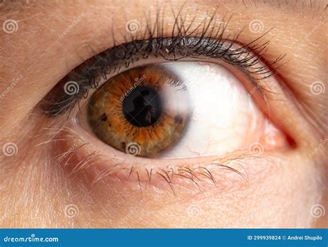 Moles in the Retina of the Eye. Macro Stock Photo - Image of mole, closeup: 299939824