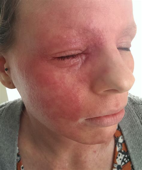 Eczema Rash Postpartum at Helen Hart blog