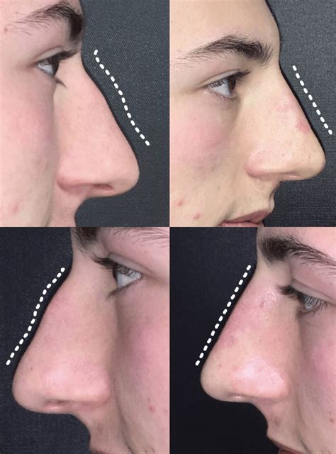 Non-Surgical Rhinoplasty NYC | Liquid Nose Job in NYC | Dr. Halaas