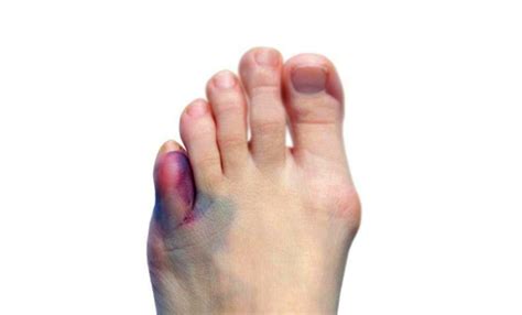 Foot Finger Fracture Symptoms at Kiara Vaux blog