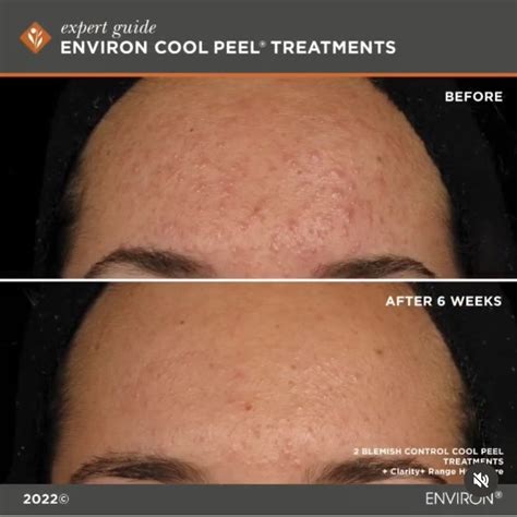 Environ Cool Peel — Bene Skin & Laser