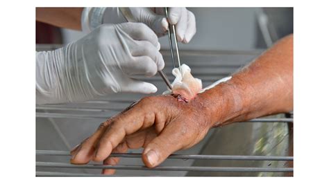 ConvaFoam™ | WoundSource