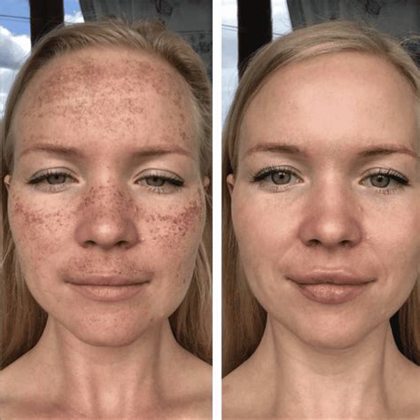 Hyperpigmentation Treatment - London Premier Laser & Skin Clinic
