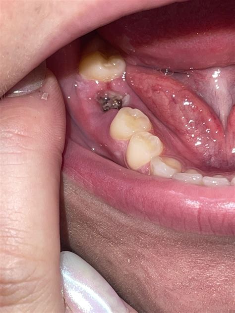 Infected Tooth Socket
