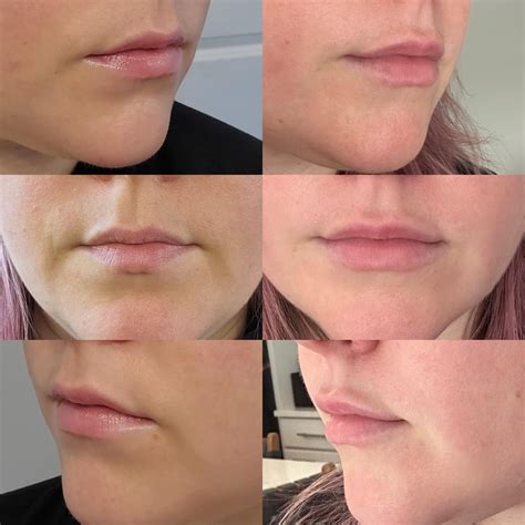 2 weeks after .5 syringe of lip filler, should I dissolve? : r/beauty