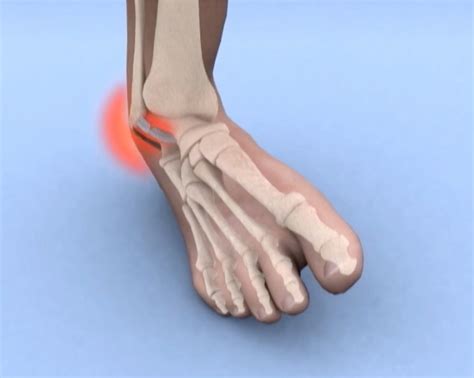 Que Es Un Esguince En El Pie at Matt Wood blog