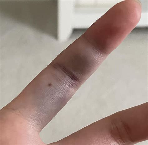 Broken or Sprained Finger. Can't get it out of bent position but iced ...