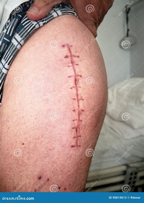 Scar Follow Surgery Of Hip Joint. Replacing Of The Devastated Hip Joint ...