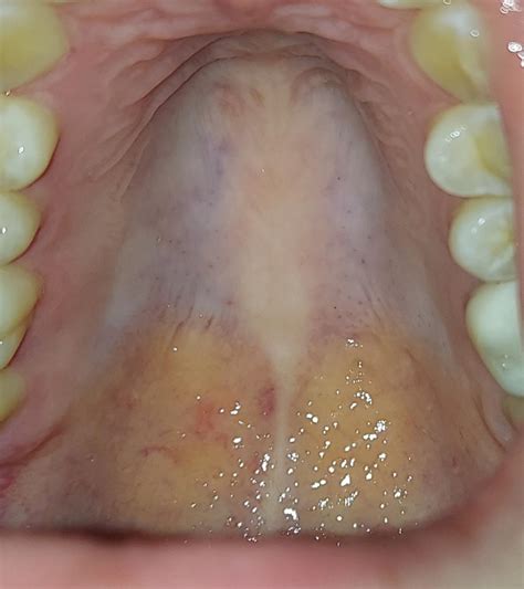 What Causes A Swollen Hard Palate at Evelyn Council blog