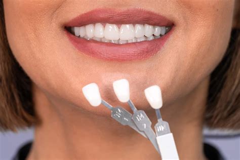 Dental Care Talk: Are Veneers Permanent?? - Big Smile Dental