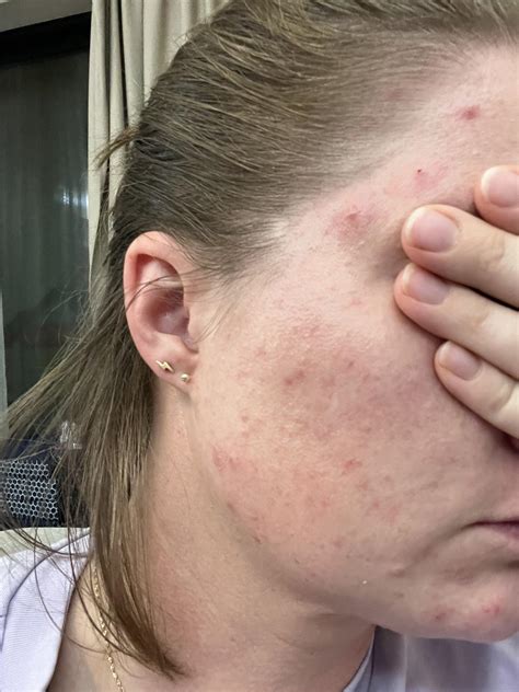 Help! Huge breakout after dermaplaning (35F). What happened? : r/30PlusSkinCare