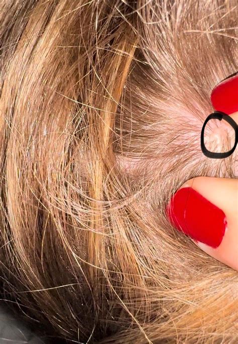 Skin colored bump on scalp : r/DermatologyQuestions