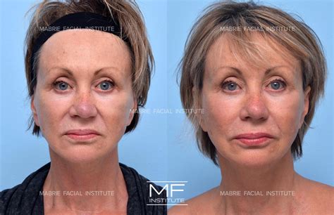Nasolabial Fold Treatment With Filler & BOTOX® in the San Francisco Bay Area – Mabrie Facial ...