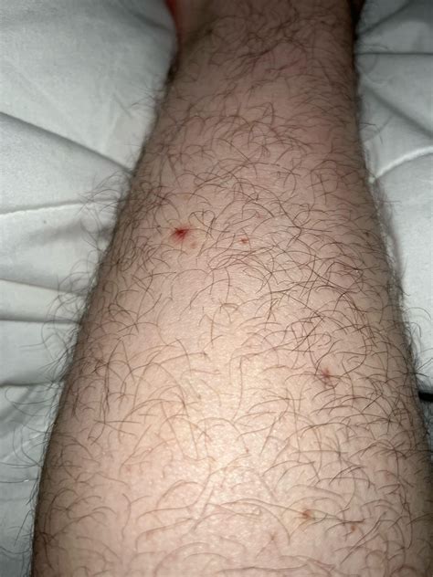 A few pimples like this randomly appears on my legs, thighs and buttocks : r/Folliculitis