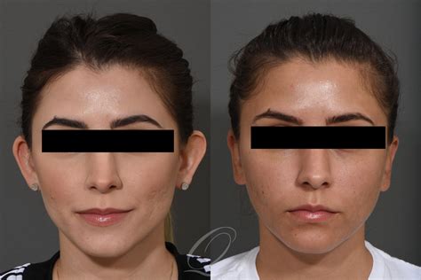 Otoplasty (Ear Pinning) Before & After Photo Gallery | Serving Rochester, Syracuse & Buffalo, NY ...