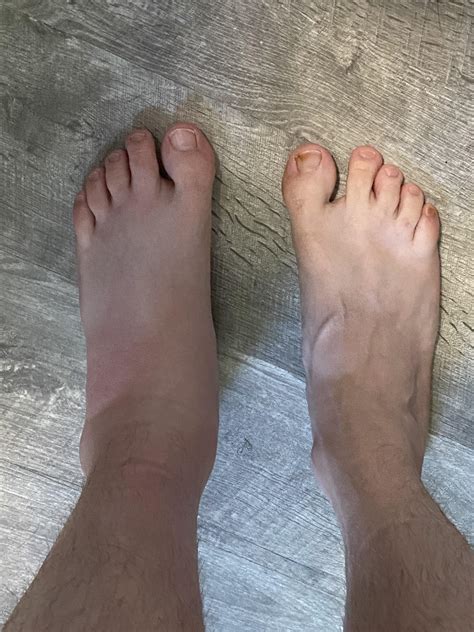 Muscle And Joint Pain After Yellow Jacket Sting at Herman Dunlap blog