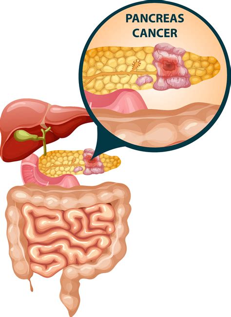 Pancreas Cancer Causes Pancreatic Cancer. Causes And Symptoms