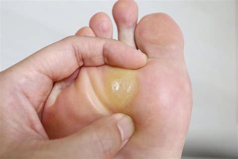 Callos En Los Pies