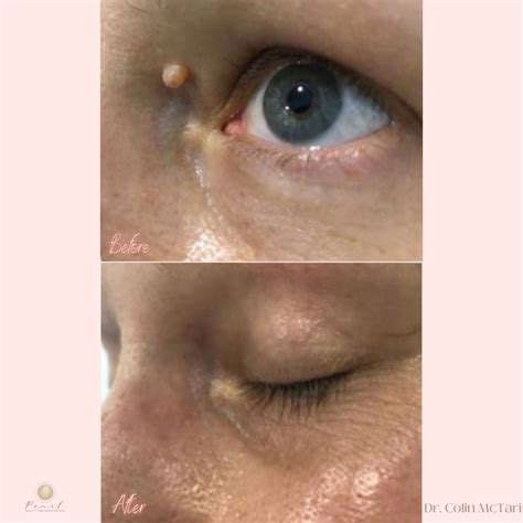 Laser Mole Removal for Facial Mole Removal or Cosmetic Mole Removal