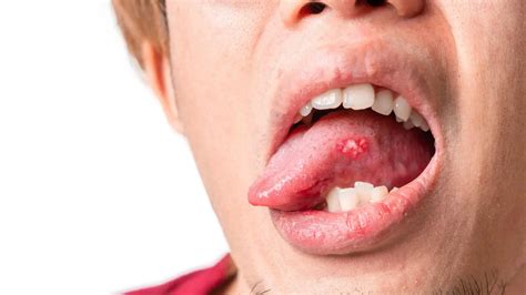 Can You Pop a Canker Sore: Why Its Not Advisable