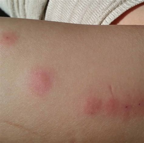 Bed Bugs Bite Photos: 2 Close Up Photos Of Bed Bug Bites