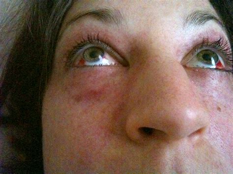 Eyes Blood Vessel After Vomiting at Samantha Tomlinson blog
