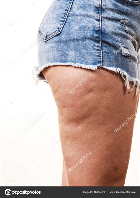 Bad Cellulite On Back Of Thighs