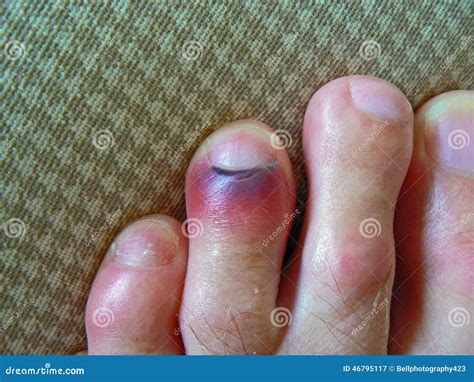 Swollen And Bruised Toes With Out Of Focus Background Stock Image ...