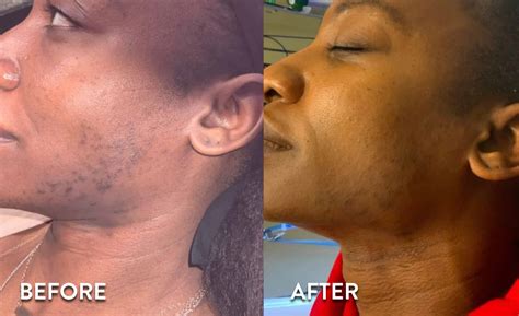 Laser Hair Removal Before And After Face Don't Settle! How To Pick The