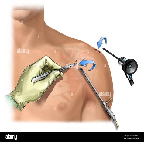 Arthroscopic shoulder surgery hi-res stock photography and images - Alamy